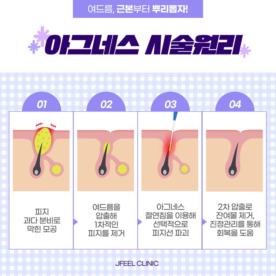 마드름 끝장내기? 제이필 마그네스 이벤트로! 관련 이미지 11