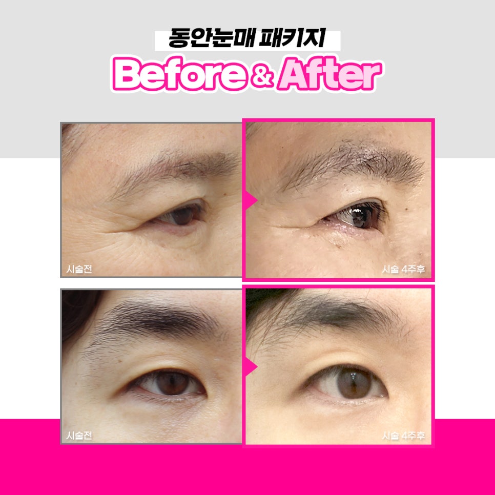 처진 눈가, 눈밑지방을 비수술하안검으로 또렷하고 선명하게 관련 이미지 6