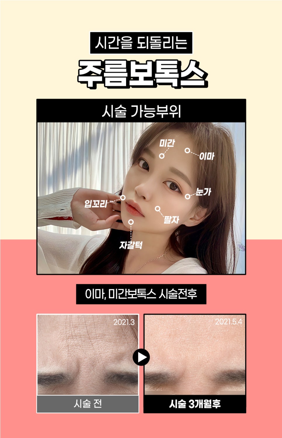 턱주름보톡스, 주름은 팽팽하게 턱은 갸름하게 관련 이미지 5