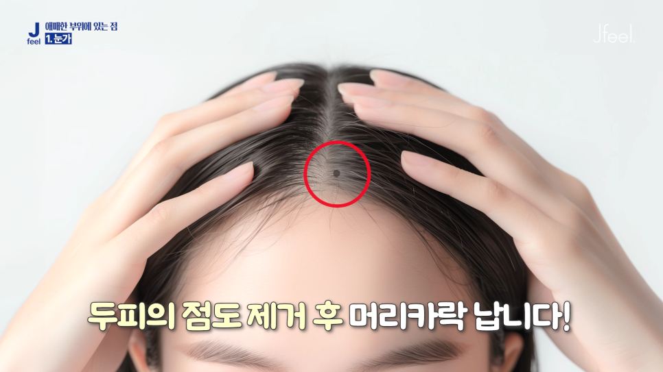 Hongdae Mole Removal: Can Moles Under the Eyes, Beside the Eyes, and on the Lips Also Be Removed? Aftercare Following Mole Removal image 6