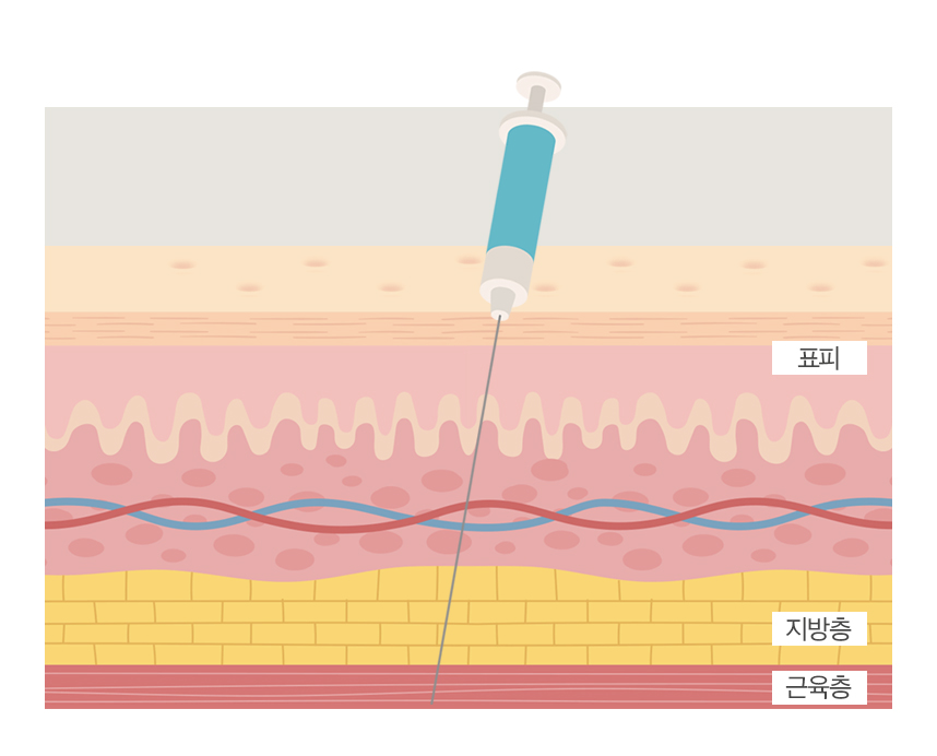 직각어깨 만드는 법, 승모근 보톡스 맞아도 안 되는 이유 관련 이미지 3