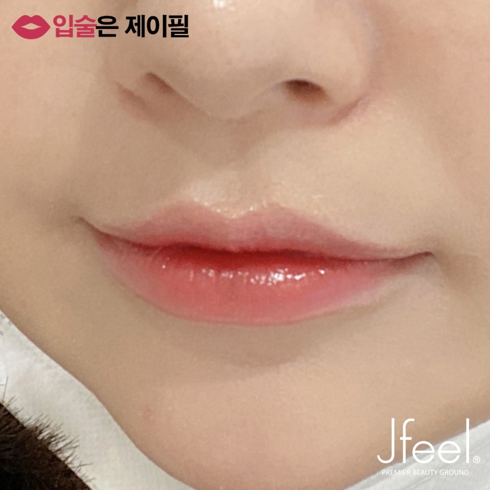 입술필러 맞고 조심해야 할 점, 주의사항, 통증, 붓기 관련 이미지 9