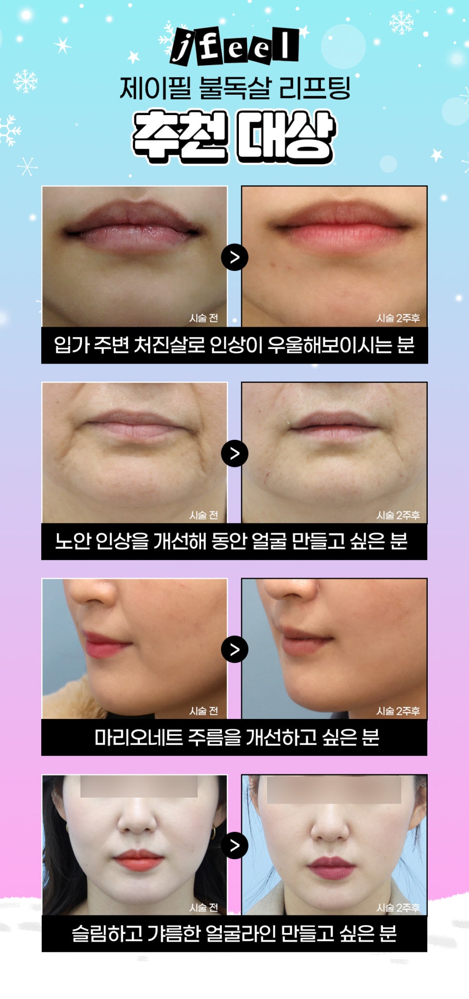마포피부과 불독살리프팅을 찾는 이유 관련 이미지 7