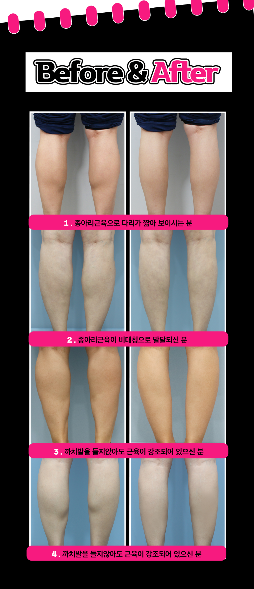 종아리근육빼기, 보톡스로 날씬한 다리 만들기 관련 이미지 6