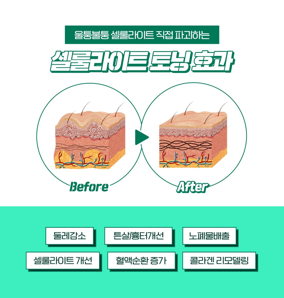 군살빼기, 군살삭제패키지로 진짜 지방까지 관련 이미지 5