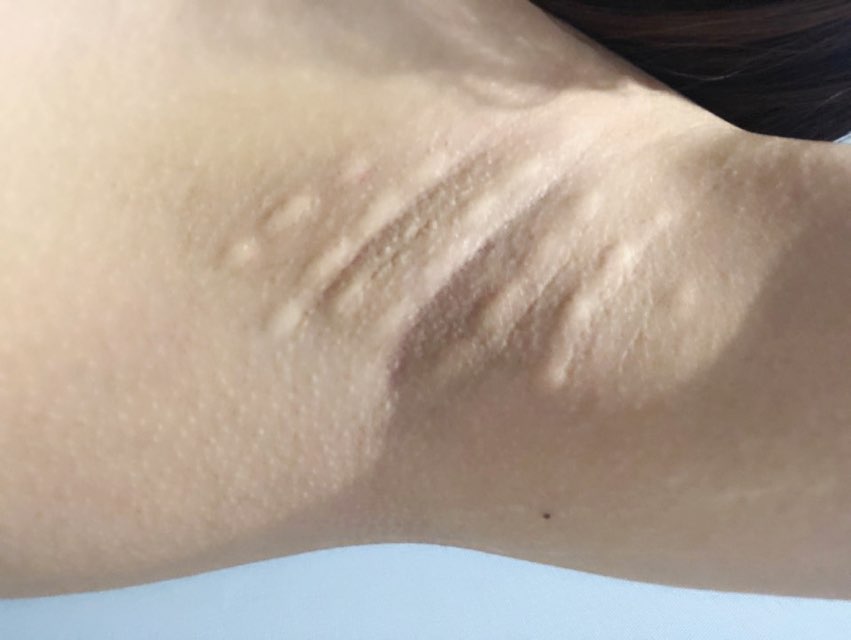 [홍대피부과] 제이필의원 여름 대비 다한증 보톡스, 겨땀 안녕 관련 이미지 6