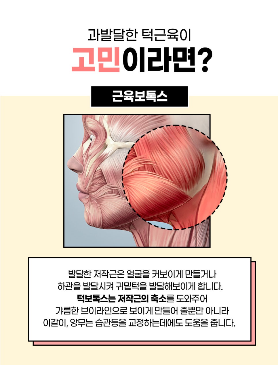 턱주름보톡스, 주름은 팽팽하게 턱은 갸름하게 관련 이미지 3