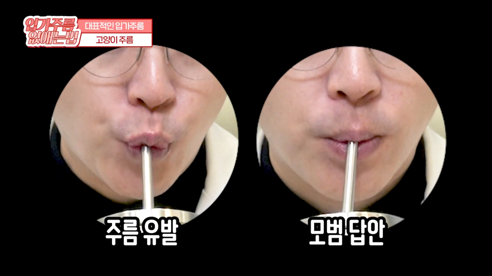 입가주름시술, 원인부터 치료, 예방까지 한 번에 관련 이미지 15