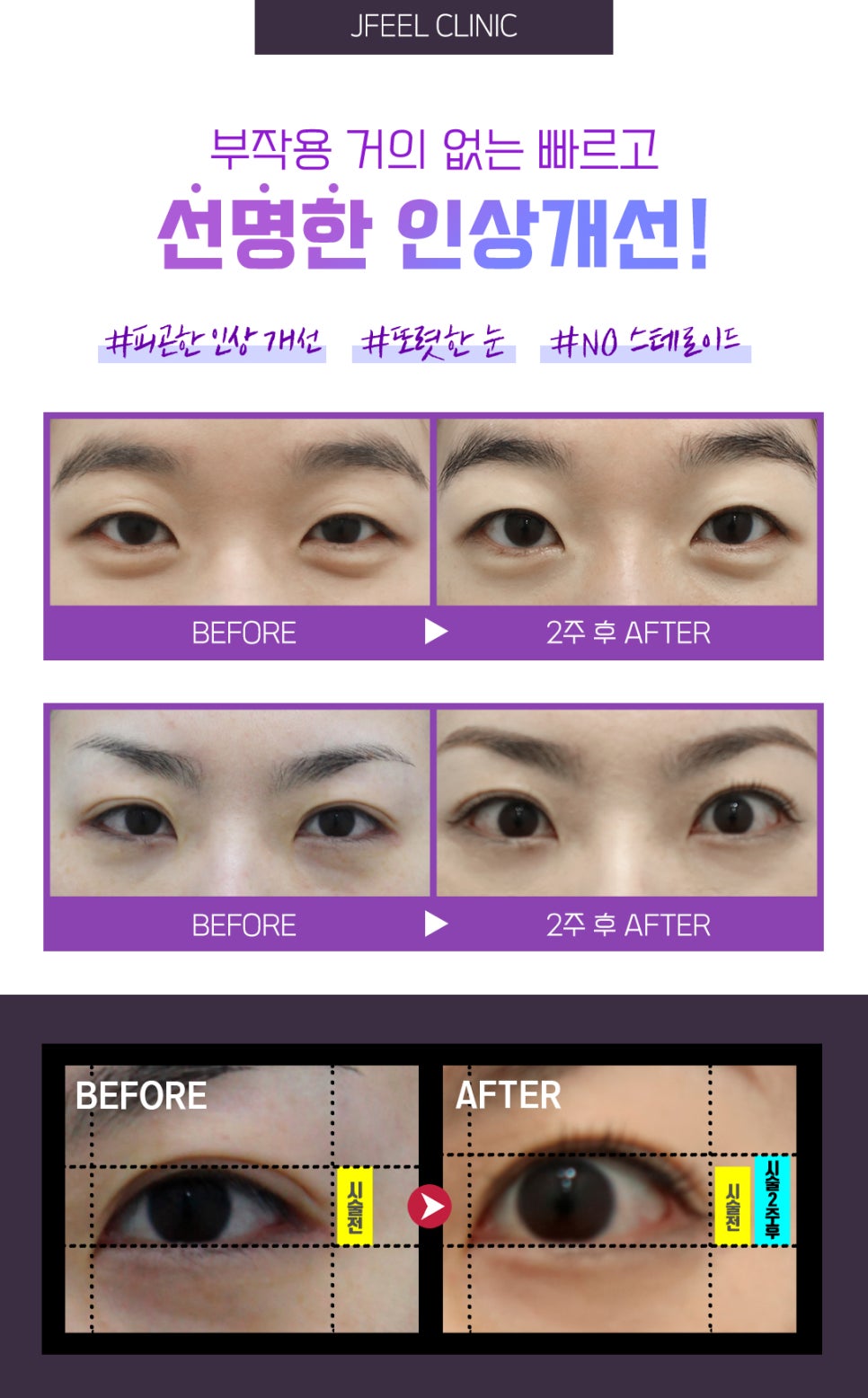 무거운 눈지방을 주사로 제거가 가능하다면? 관련 이미지 5