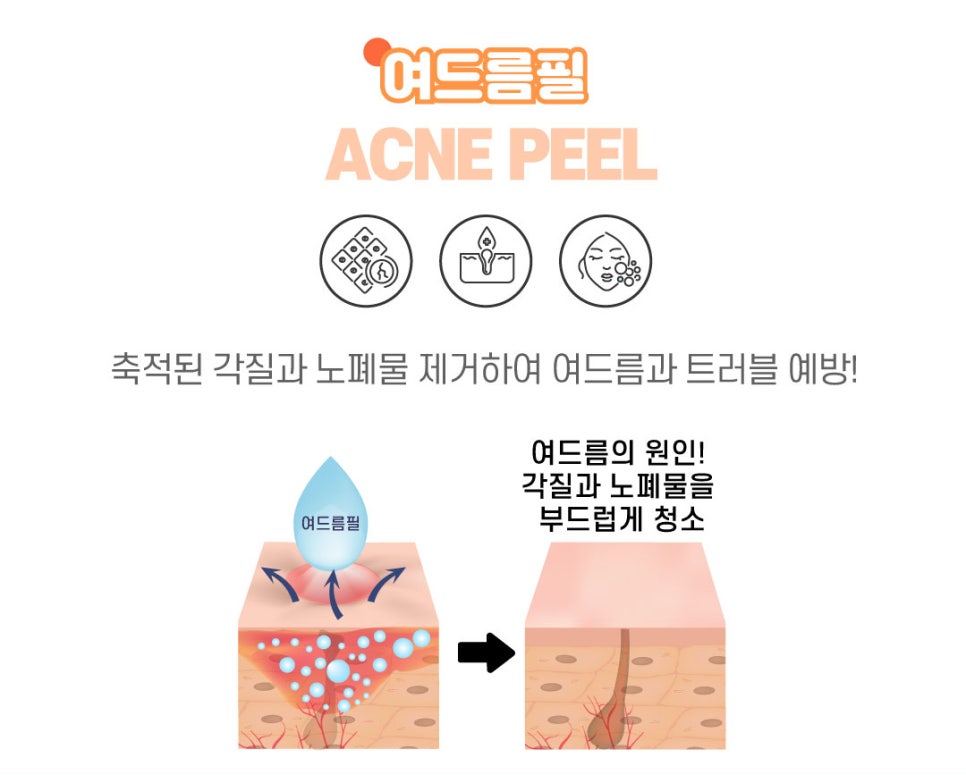 여드름과 흉터 개선에 도움을 주는 치료 방법 관련 이미지 9