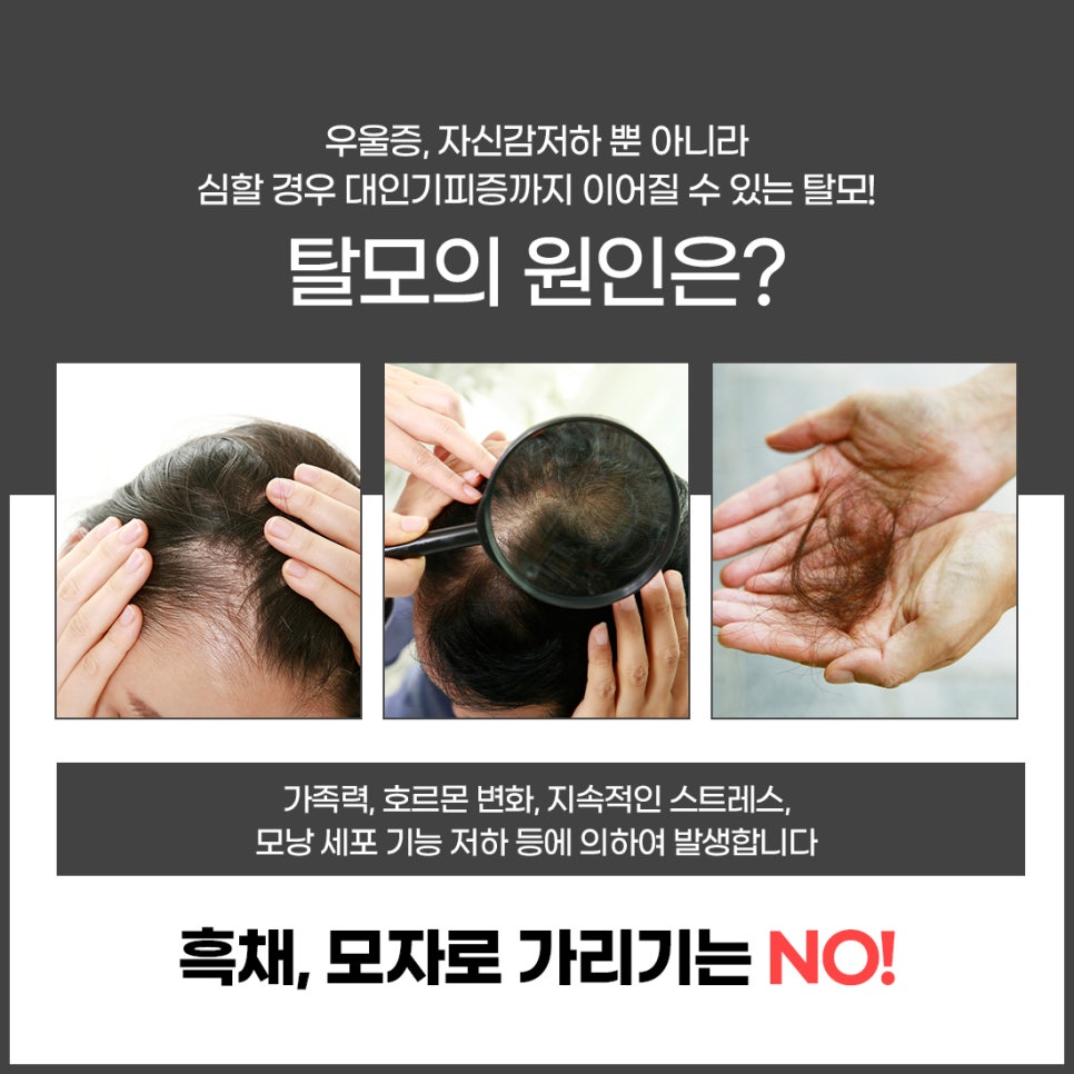홍대두피 탈모보톡스로 고민 해결 관련 이미지 2