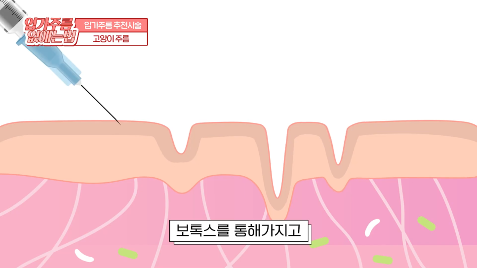 입가주름시술, 원인부터 치료, 예방까지 한 번에 관련 이미지 16