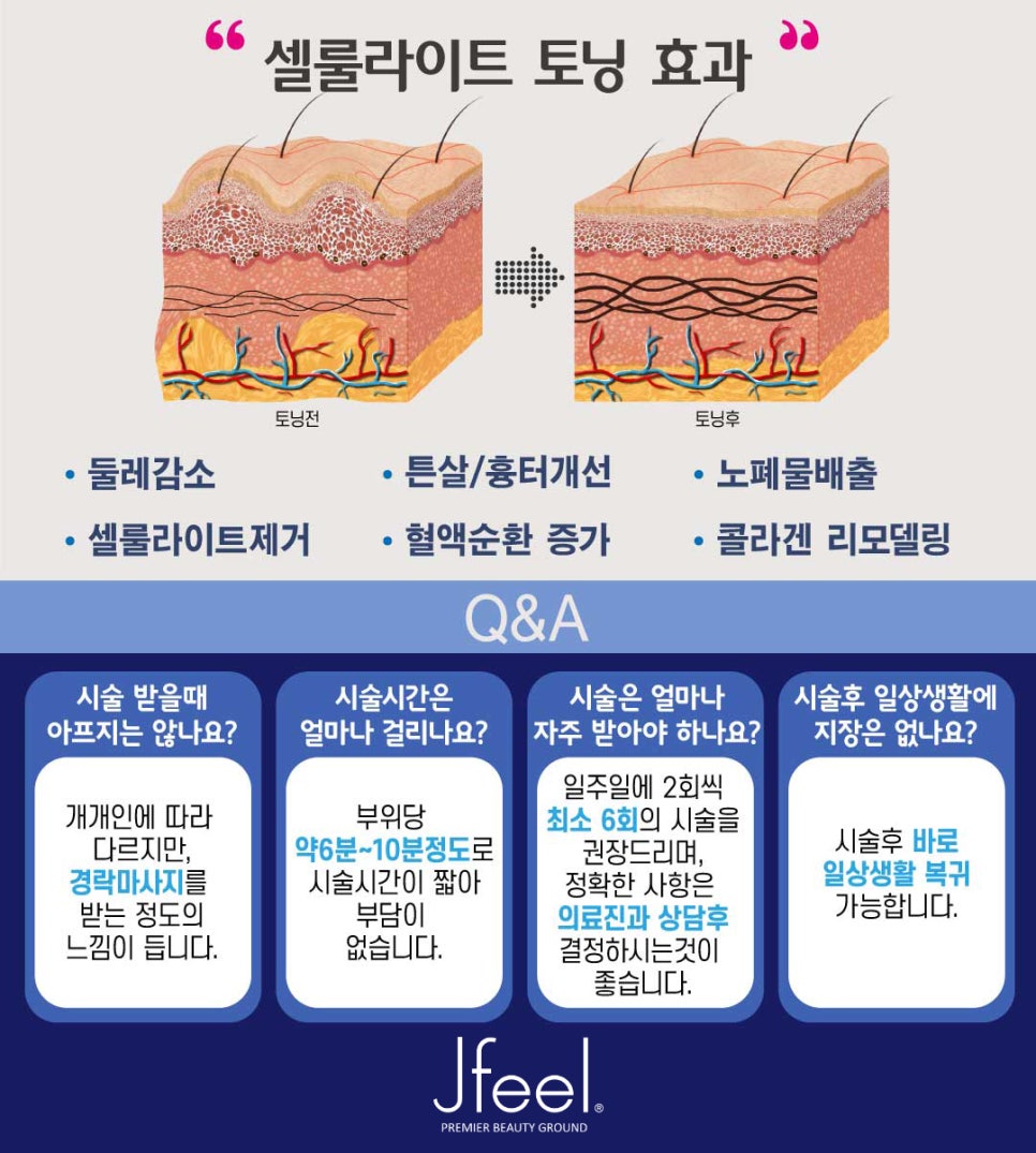 [홍대피부과] 제이필의원 셀룰라이트 토닝, 정품 X-WAVE 관련 이미지 2