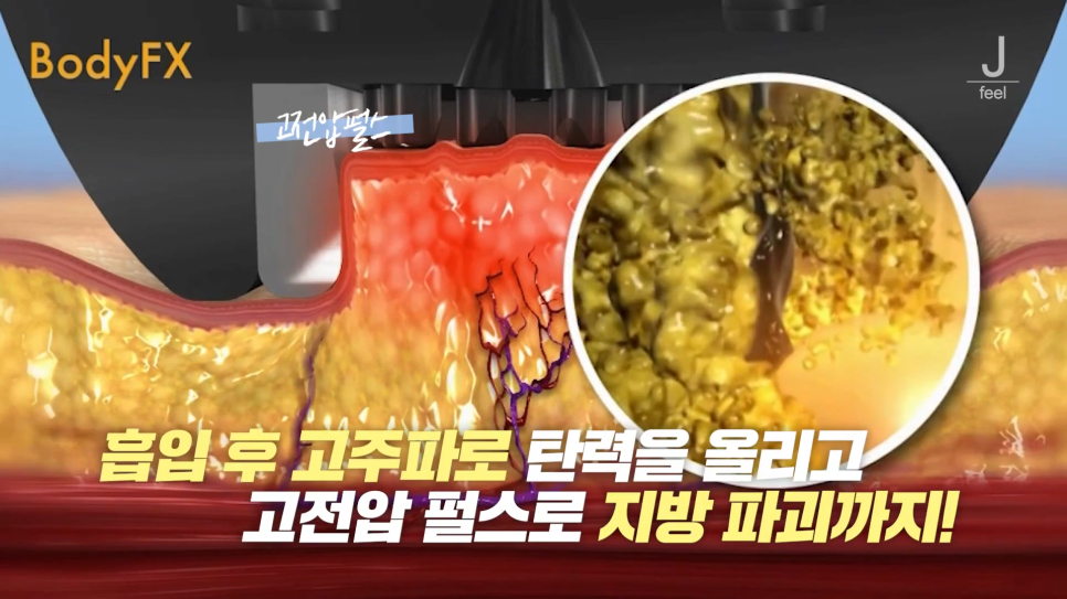 인모드와 튠페이스&튠라이너 차이점 관련 이미지 5