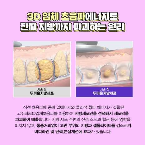 강남 튠페이스 리프팅 │ 온다&middot;소프라노티타늄 비교, 탄력레이저 선택 기준 정리 관련 이미지 15