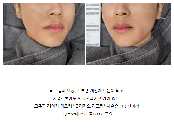 홍대올리지오리프팅 써마지보다 가성비 넘치는 후기! 관련 이미지 3