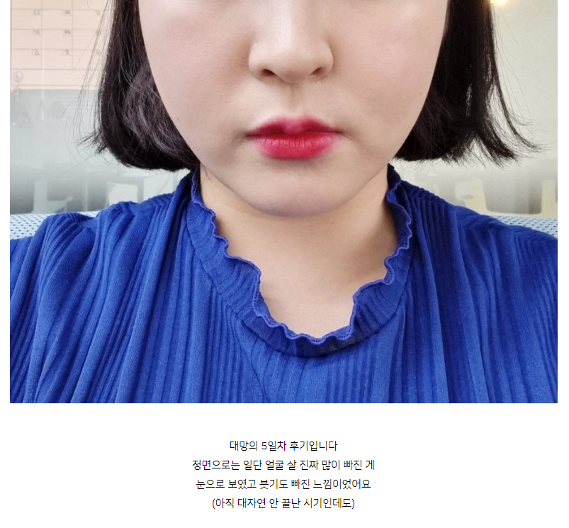 이중턱, 심부볼 윤곽주사 스테로이드 없는 후아유 후기 관련 이미지 1