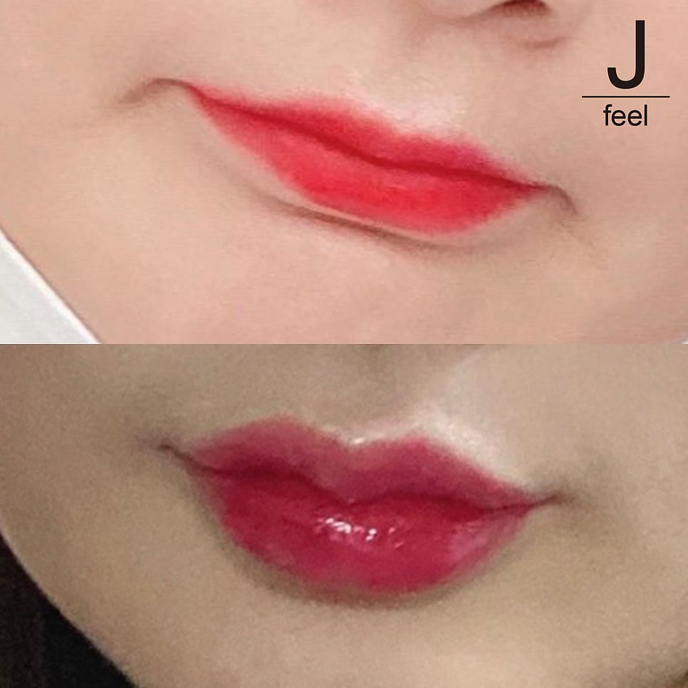 입술필러 잘하는 곳 제이필에서 부작용 걱정없이 사랑스럽게 관련 이미지 1