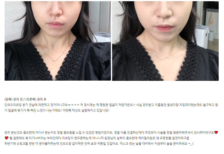 인모드리프팅 FX ,포르마 후기&hearts; 효과시기 궁금하셨던 분들 주목! 관련 이미지 1