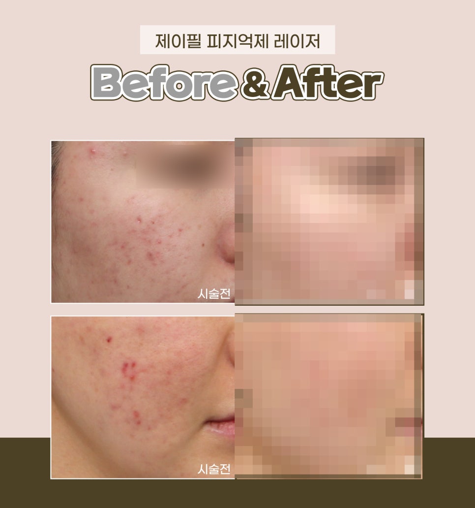 피지분비, 피지억제레이저로 여드름 끝장내기! 관련 이미지 8