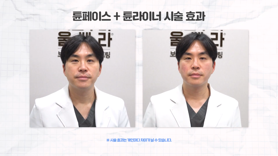 얼굴라인 30분 만에 완성, 튠페이스 튠라이너 관련 이미지 7
