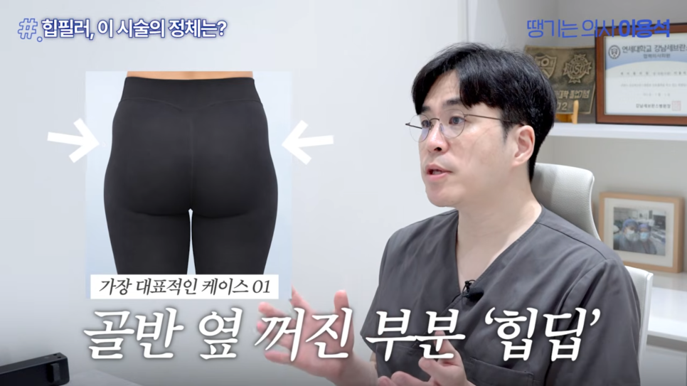 Why Butt-Only Workouts Aren't Enough｜When Hip Fillers Are Needed for Hip Dips image 23