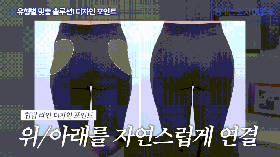 힙필러, 얼마나 넣어야 할까? 힙딥 원인부터 자연스러운 골반라인까지 관련 이미지 4