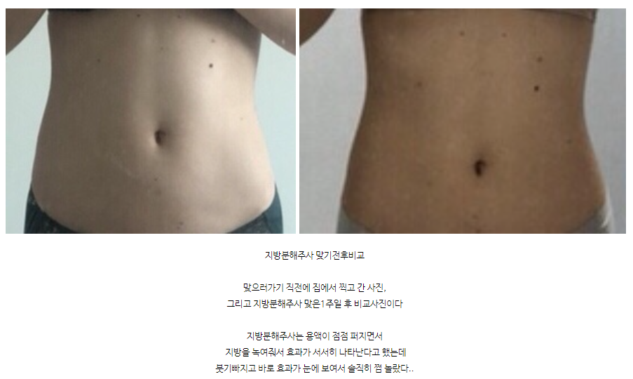 옆구리살빼는법 홍대지방분해주사 퀸주사 후기 관련 이미지 2