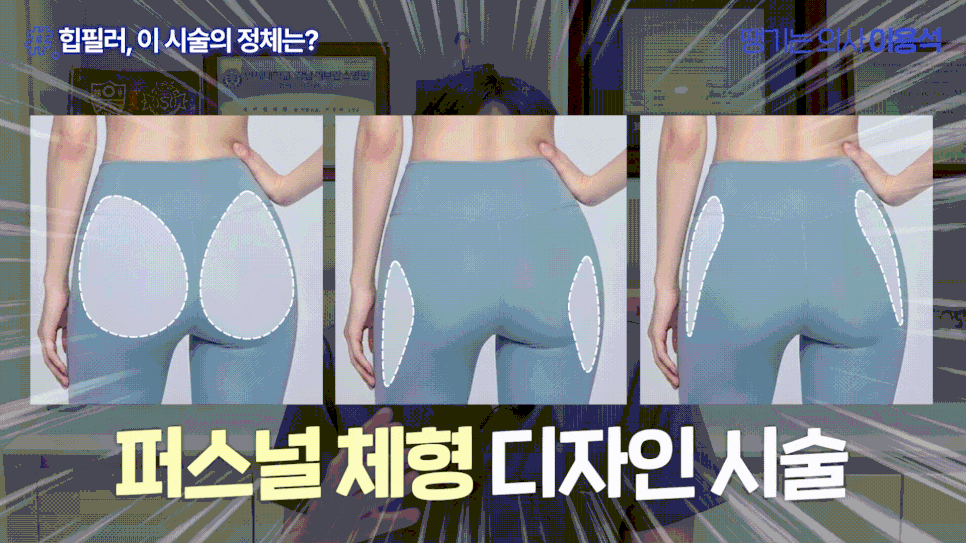 힙필러 전 꼭 알아야 할 사실|힙딥은 단순히 볼륨보다 구조가 중요합니다 관련 이미지 21