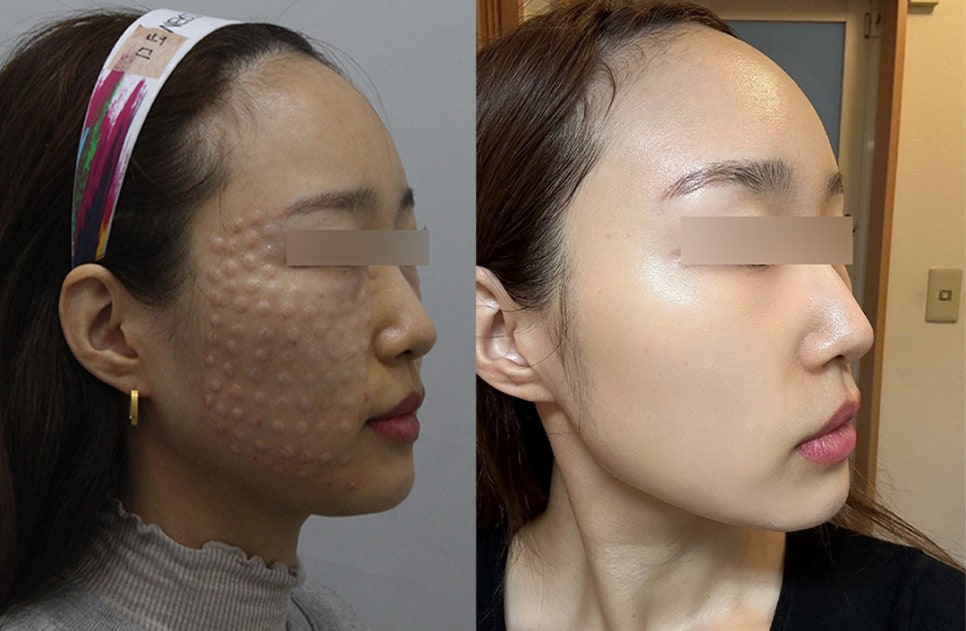 스킨부스터, 이건 꼭 알고 하세요! ｜ 리쥬란 힐러, 물광주사 관련 이미지 4