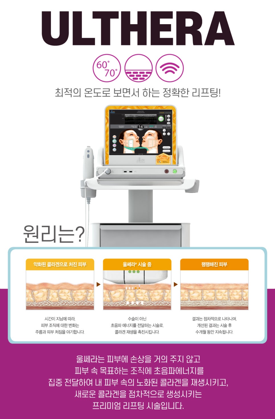 인모드,울쎄라를 이용한 리프팅 시술시 효과와 주의사항 관련 이미지 8
