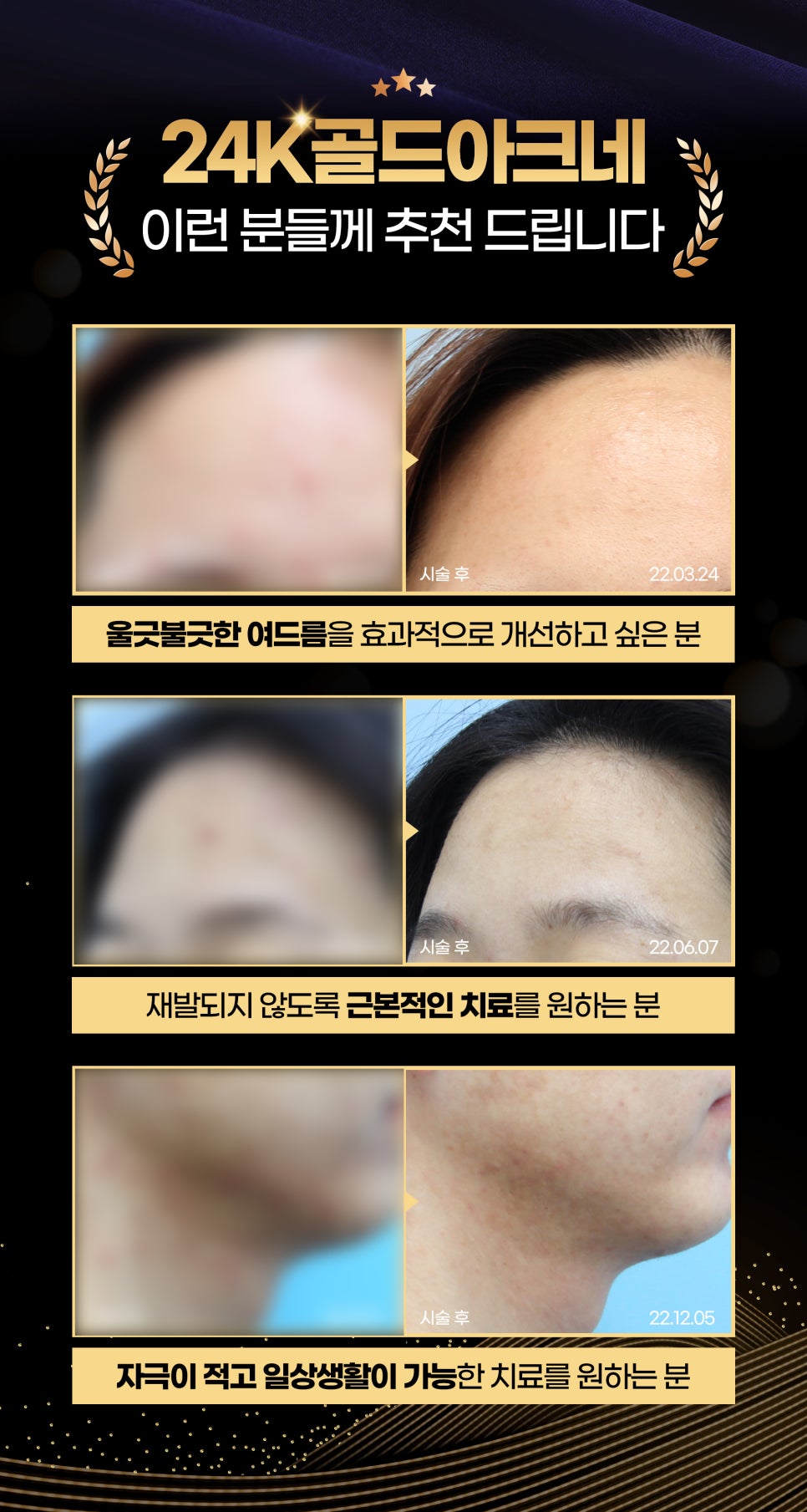 여드름피부치료 끝판왕! 24k 골드 혁명 관련 이미지 7