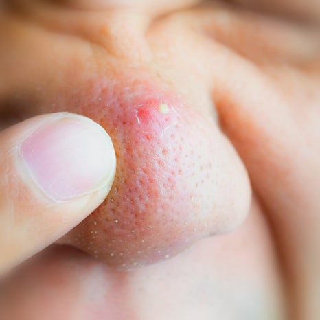 Summer Sebum · Pore · Lifting Care Guide｜Jfeel Clinic July Programs image 4