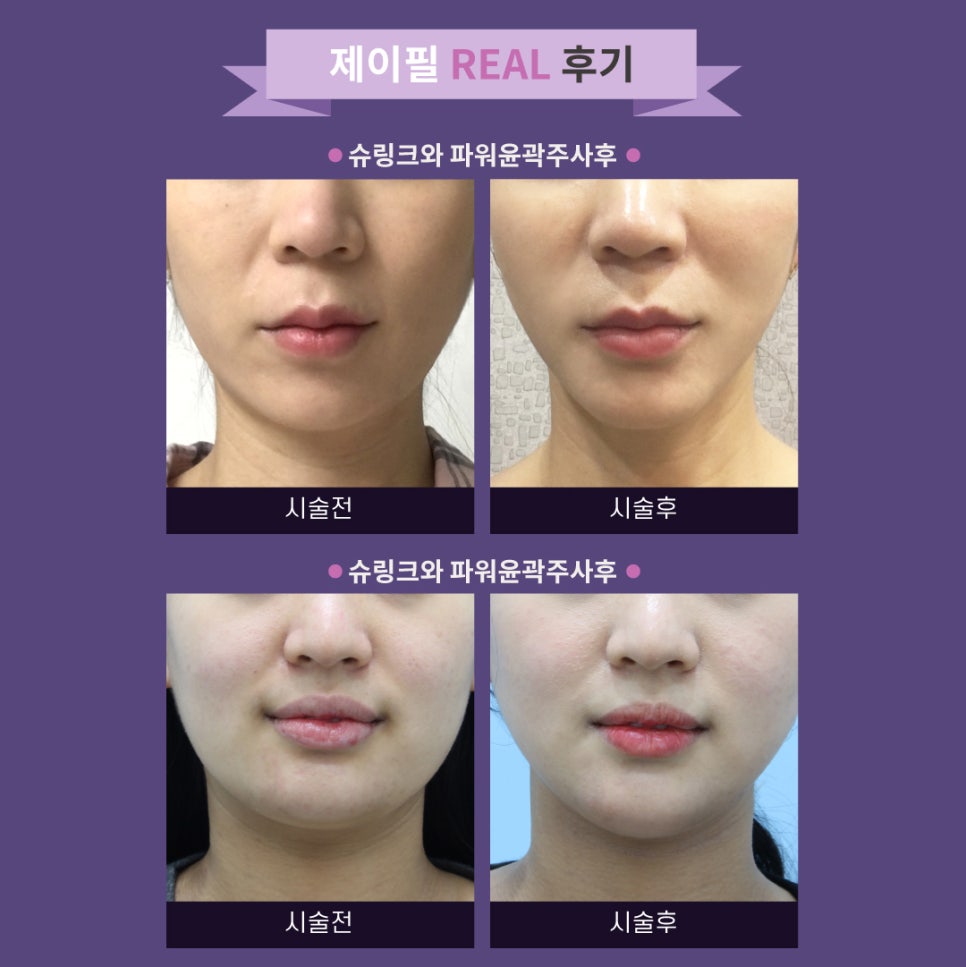 [홍대피부과] 진정한 V라인은  슈링크+제이필 파워윤곽주사 로 완성 관련 이미지 6
