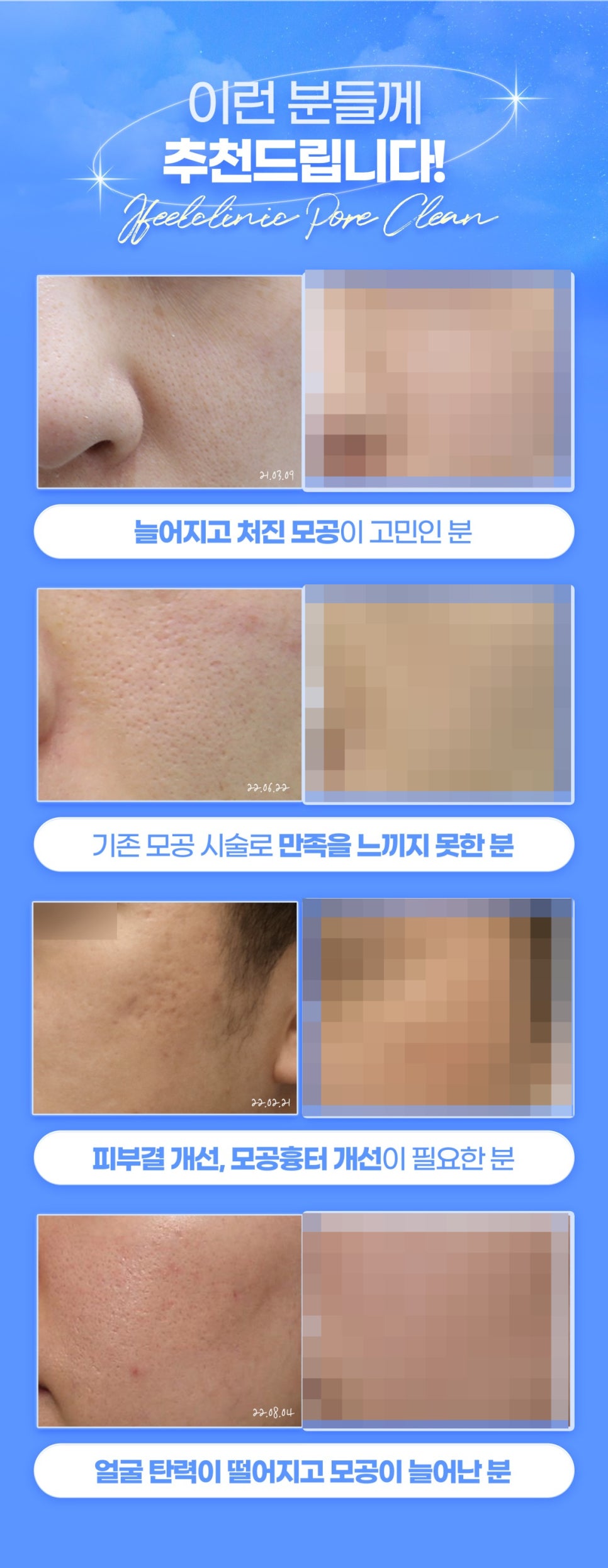 넓은모공 줄이는 모공손절패키지 관련 이미지 7
