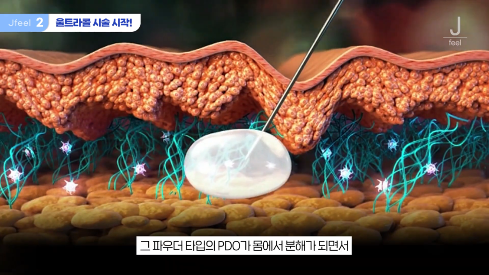 필러가 싫다면? 눈가, 팔자, 주름 해결하는 울트라콜 관련 이미지 6