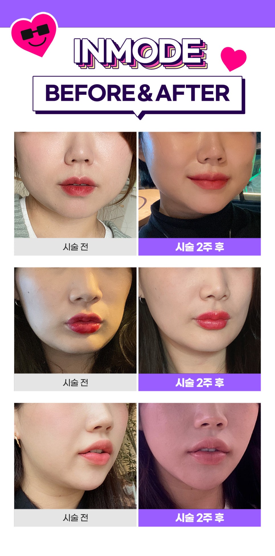 홍대인모드로 얼굴 라인 정리 관련 이미지 8