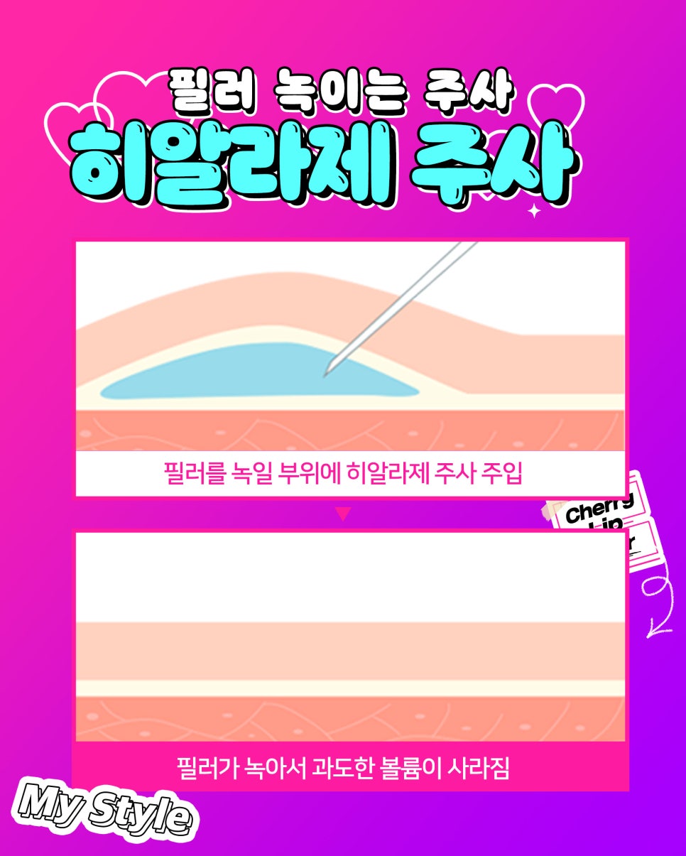 얼굴 동안시술로 자연스럽게 예뻐지고 싶다면? 관련 이미지 7