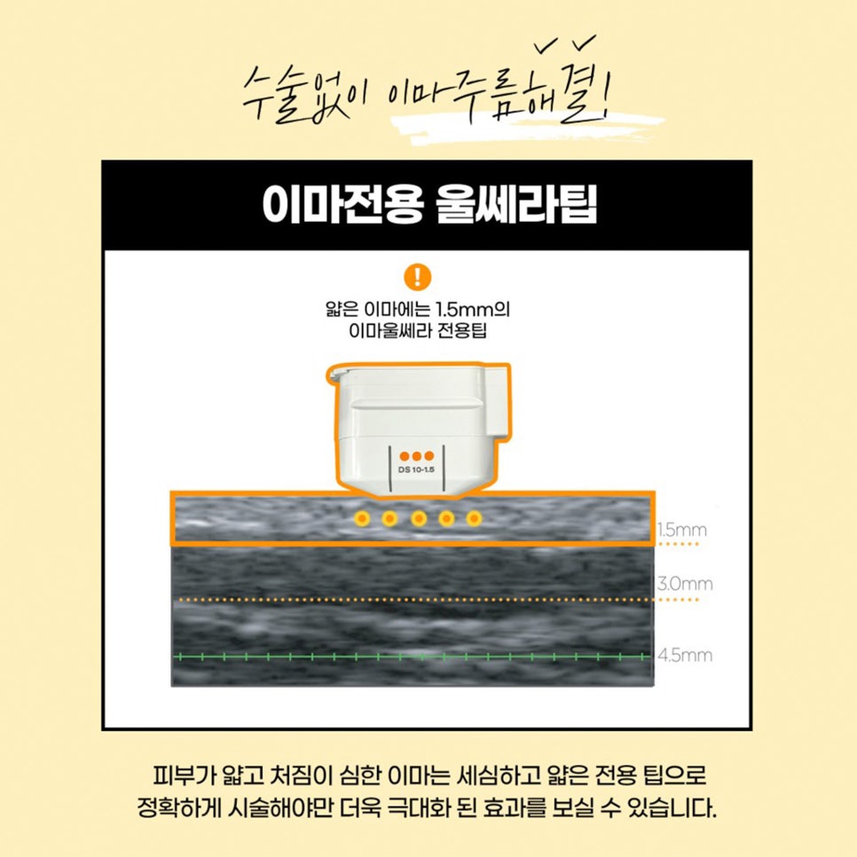 탄력리프팅, 제이필의 풀페이스울쎄라로 속부터 탄력감 있게! 관련 이미지 5