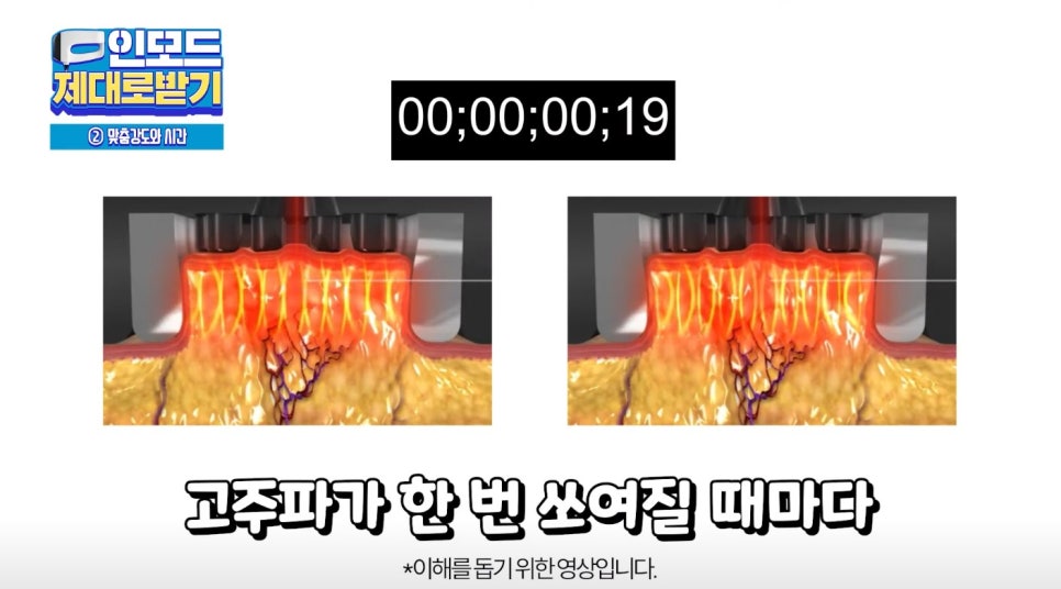 인모드효과 못 보셨다면 여기로 관련 이미지 20