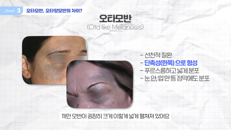 홍대 피부과 기미 잡티제거 레이저 및 구분법 관련 이미지 7