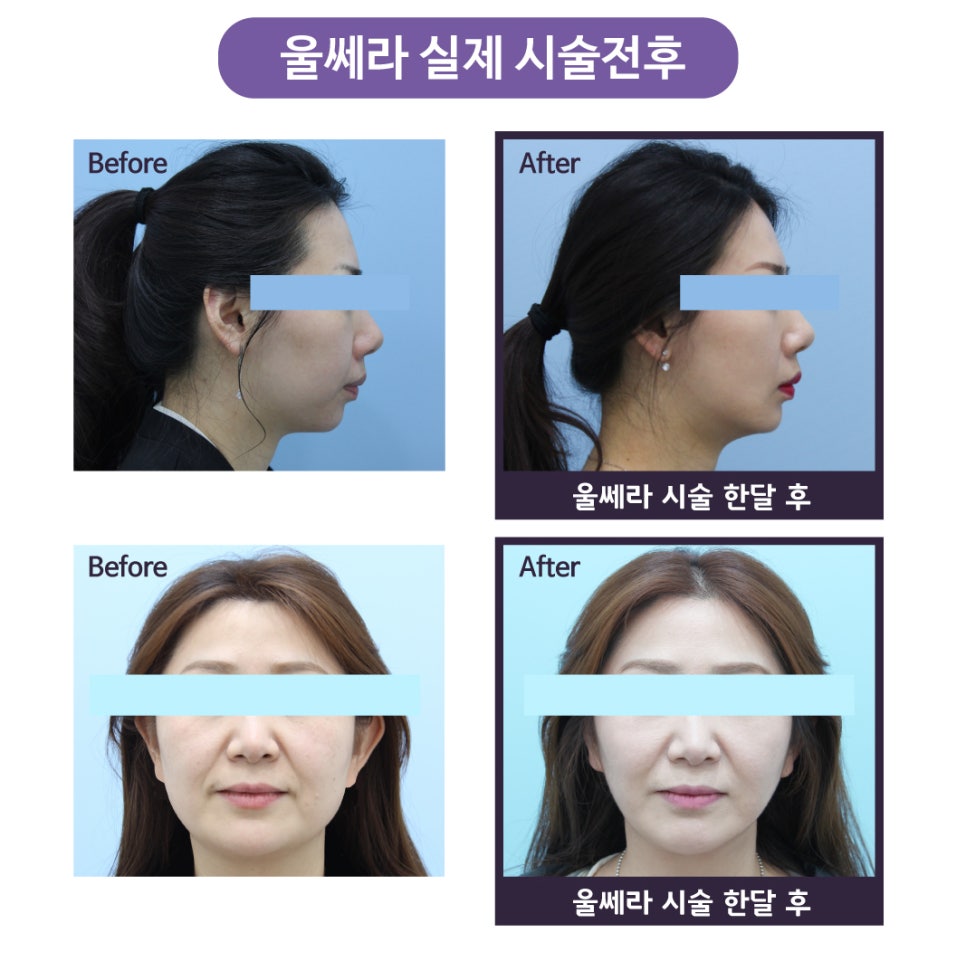 [홍대피부과]울쎄라(Ultherapy)는 제이필! 슈링크 잘하는 곳이, 울쎄라도 잘한다. 관련 이미지 8