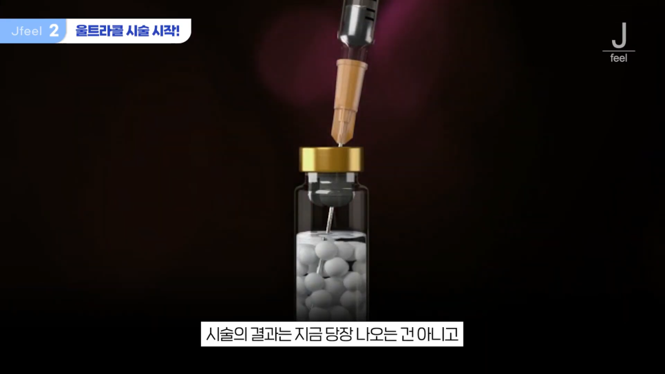 필러가 싫다면? 눈가, 팔자, 주름 해결하는 울트라콜 관련 이미지 5