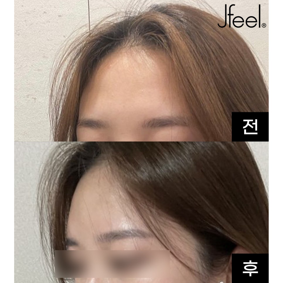 홍대 이마필러 잘하는 곳, 벨로테로 리얼 후기 관련 이미지 1