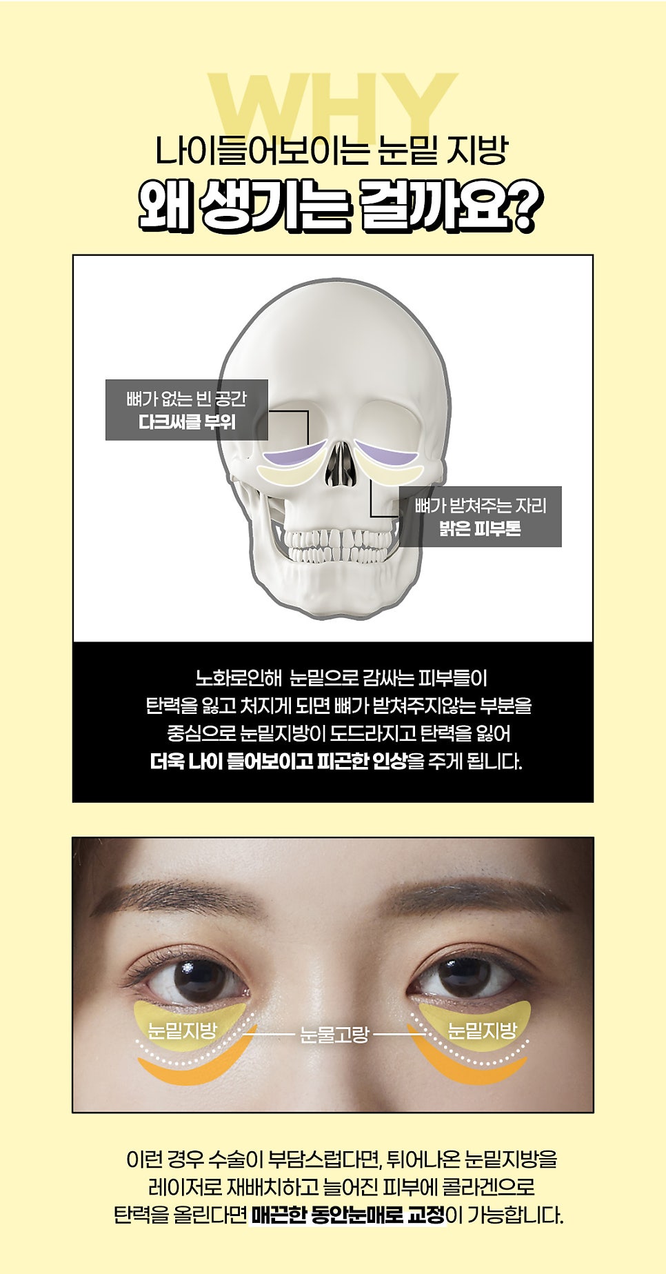 눈밑노화, 비수술 비절개 눈밑하안검으로 관련 이미지 2