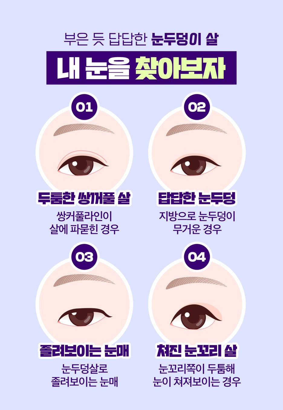 NO스테로이드 눈두덩주사로 눈두덩이지방제거 가능? 관련 이미지 3