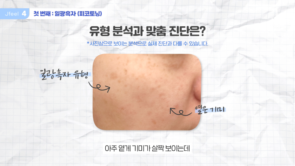 홍대 피부과 기미 잡티제거 레이저 및 구분법 관련 이미지 10