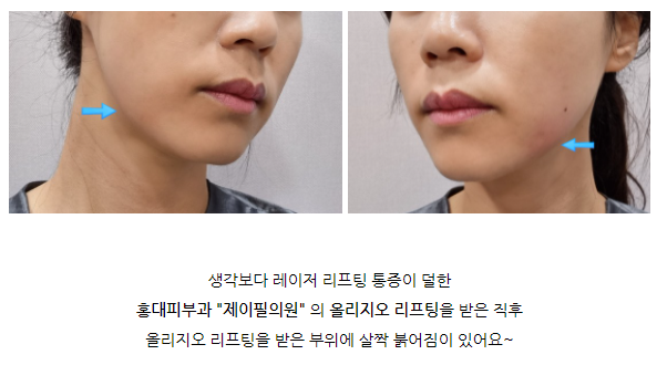 홍대올리지오리프팅 써마지보다 가성비 넘치는 후기! 관련 이미지 4