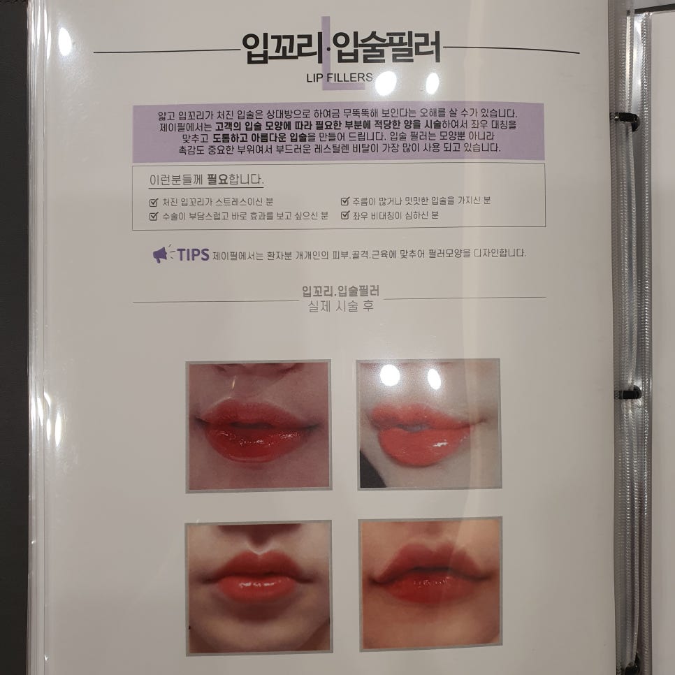입술필러 유지기간 얼마나 되나요? 관련 이미지 10