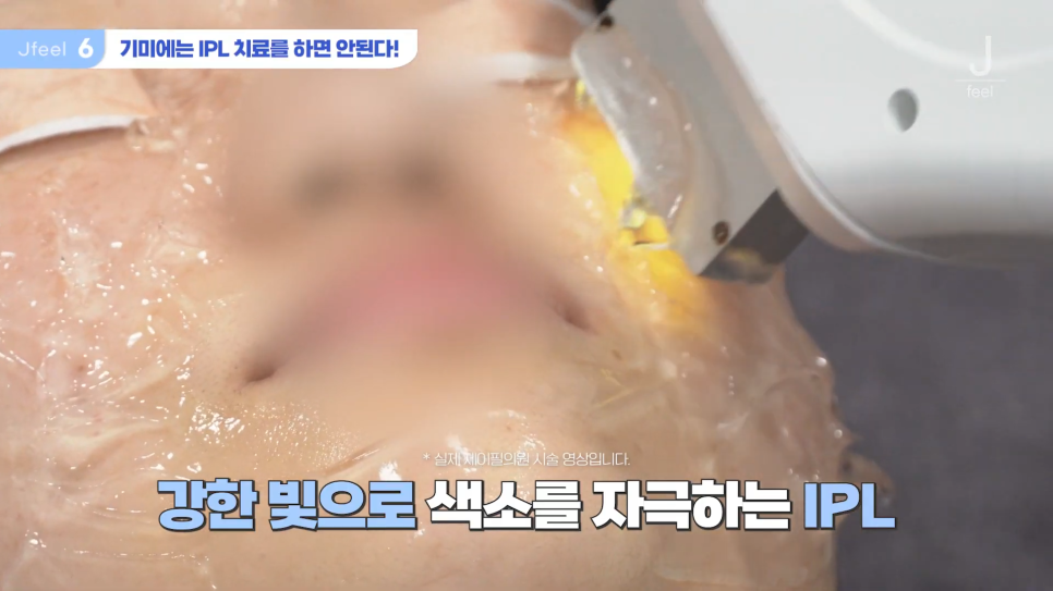 기미 주근깨 잡티에 이 시술만은 NO! 시술 전 필독 관련 이미지 12
